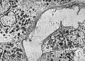 M,18y. | dilated primary bile ducts - blocked bile transport M,18y. | dilated primary bile ducts - blocked bile transport